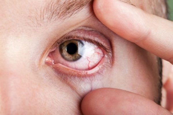 Инфицирование роговицы глаза