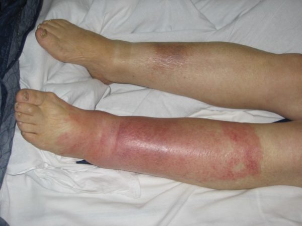 Рожистое воспаление ноги