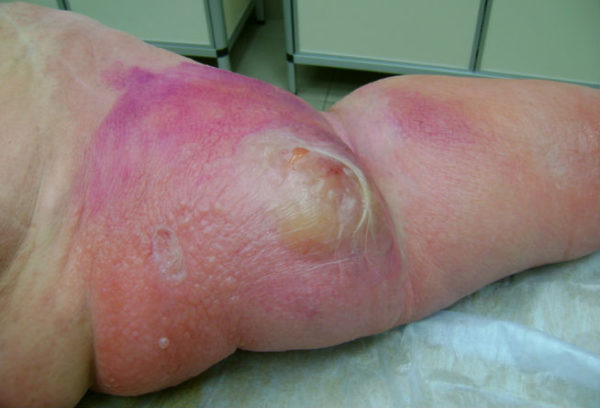 Буллезно-геморрагическое рожистое воспаление ноги