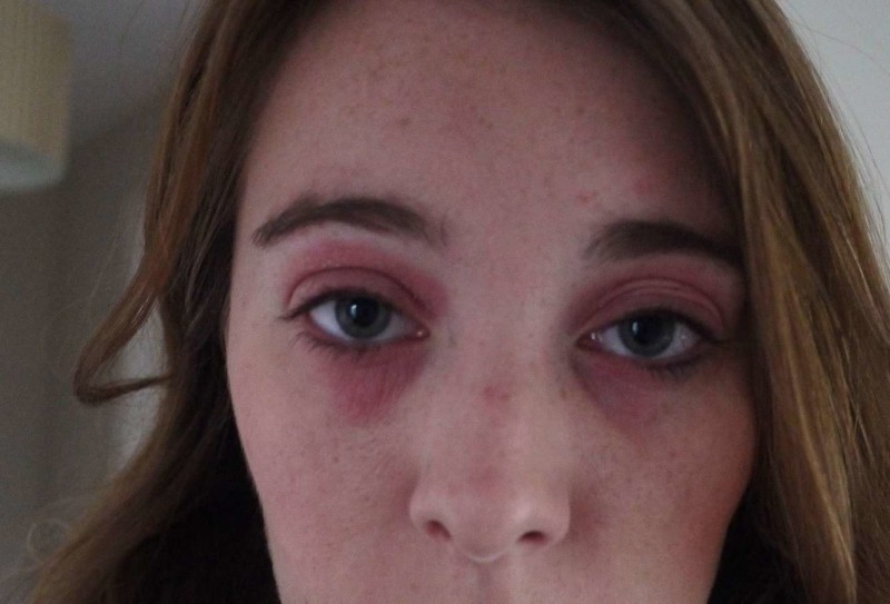 Аллергия - возможная причина появления синяков под глазами