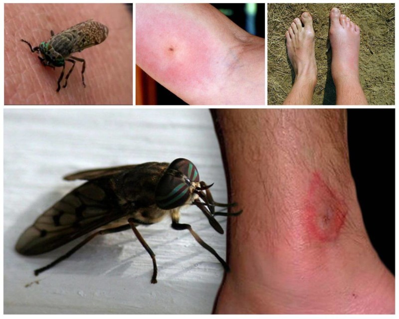 Аллергия от укуса насекомых
