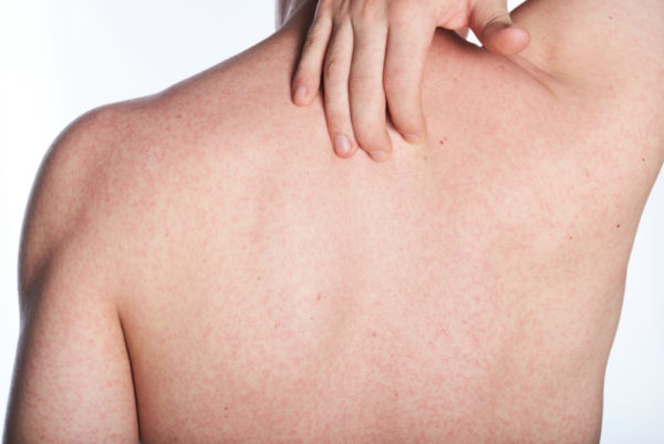 Аллергия на спине