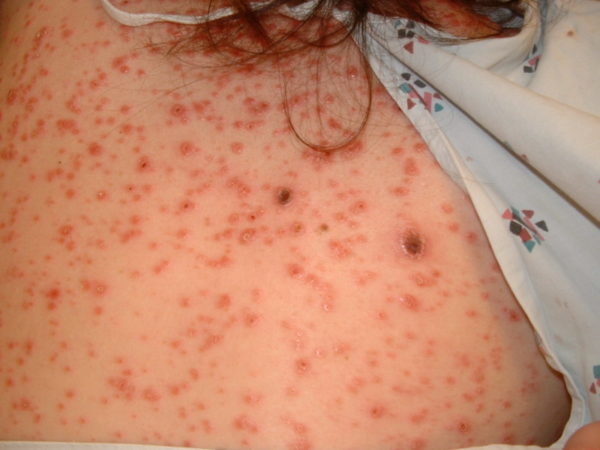Сыпь на животе при вторичном сифилисе