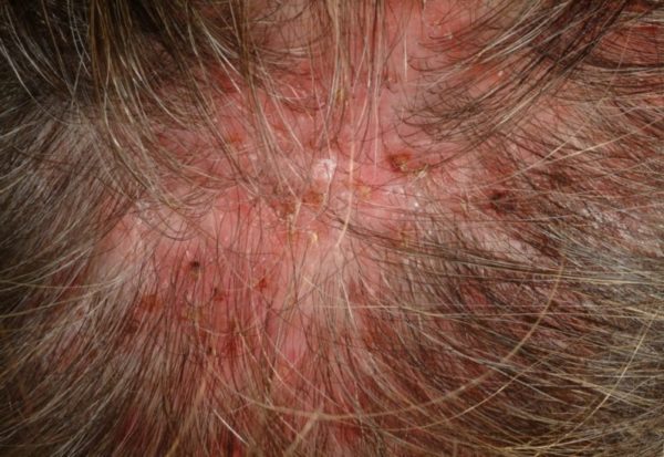 Гнойничковые болезни кожи головы