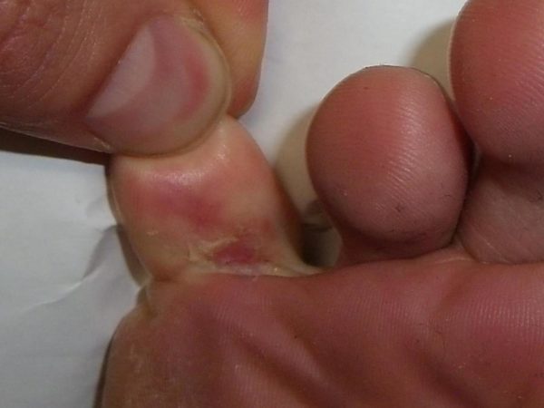 Симптомы поражения ног грибком