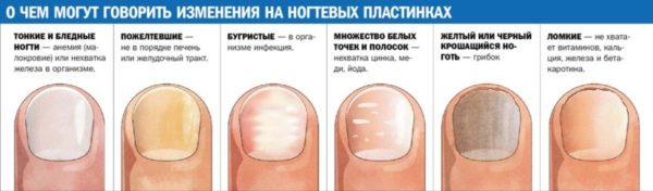 Диагностика здоровья по ногтям 