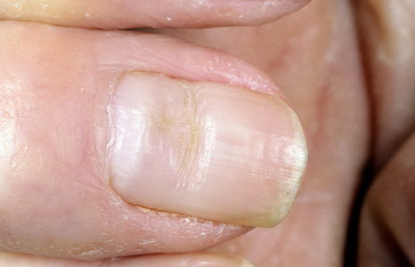 «Маникюрная» дистрофия ногтя
