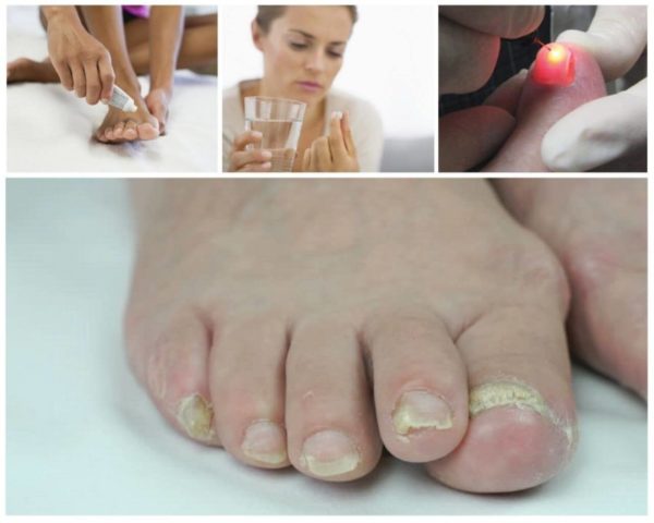 Комплексное лечение грибка ногтей