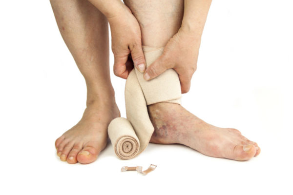 Варикозное расширение вен - одна из причин грибка ногтей на ногах