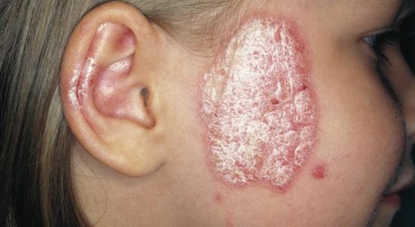 Симптомы псориаза на лице