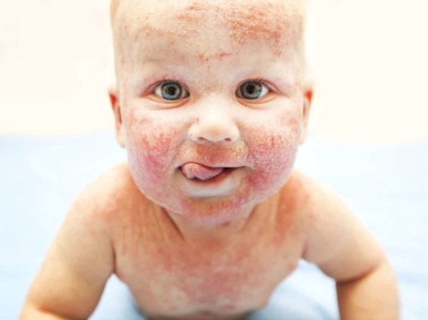 Себорейный дерматит на лице у детей