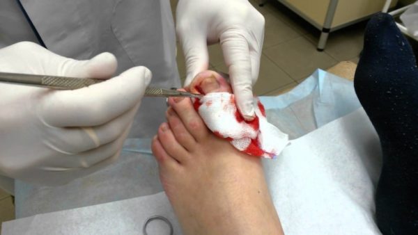 Операция по удалению вросшего ногтя