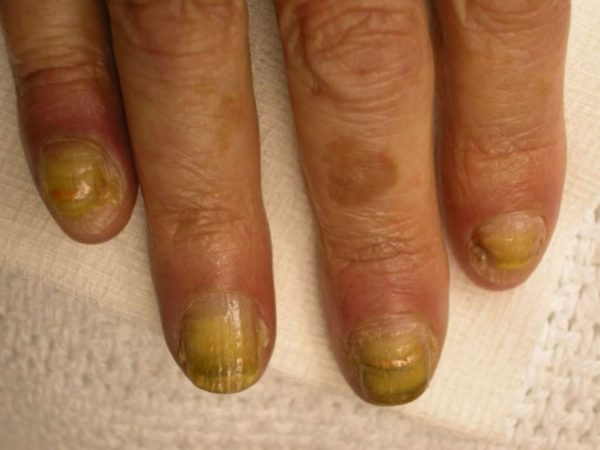 Одна из частых причин пожелтения ногтей - грибковое поражение