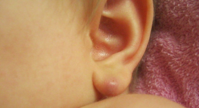 Жировик на мочке уха