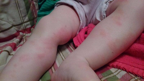 Аллергические высыпания на коже у младенца