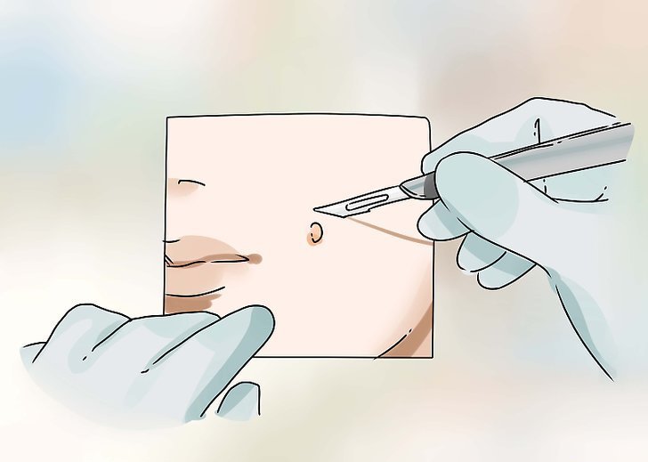 Хирургический метод