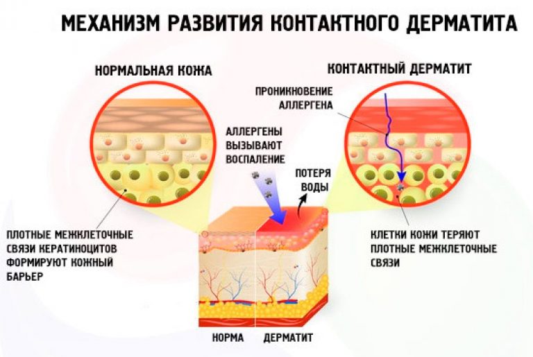 Механизм развития и причины возникновения дерматита