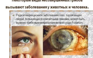 Причины появления и лечение грибковых заболеваний глаз
