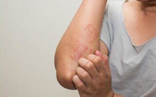 Формы аллергии на коже и методы терапии заболевания