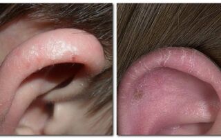 Как избавиться от себорейного дерматита в области ушей