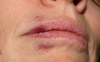 Причины появления синяков на губе и способы их быстрого удаления