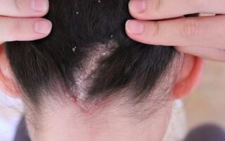 Симптомы и лечение псориаза волосистой части головы