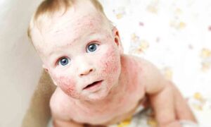 Причины возникновения и принципы лечения атопического дерматита у взрослых и детей