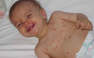 Дифференциальная диагностика и лечение вирусной экзантемы у ребенка