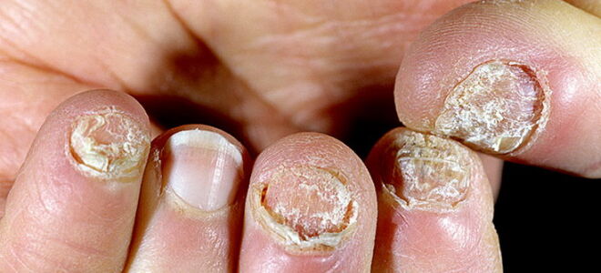 Терапия псориаза ногтей