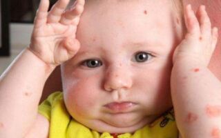 Терапия псориаза у ребенка и как предотвратить появление болезни