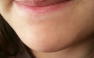 Причины появления прыщей в области губ и их лечение