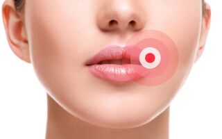 Простые и эффективные способы борьбы с герпесом на губах