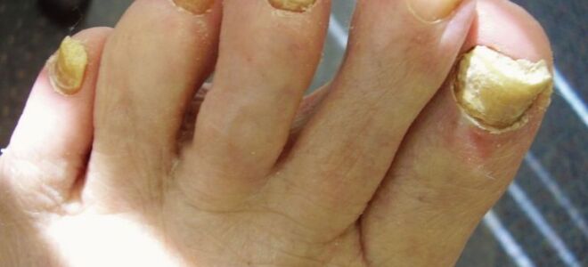 Почему увеличивается толщина ногтя и как вылечить недуг