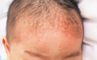 Лечение себорейного дерматита у ребенка