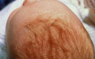 Лечение себорейного дерматита у младенцев