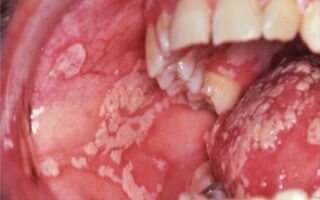 Особенности лечения молочницы в полости рта