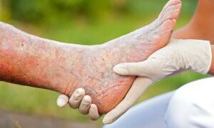 Симптомы и лечение варикозного дерматита на ногах
