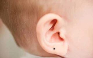 Когда требуется удаление родинки в области уха