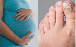 Особенности лечения онихомикоза у беременных, опасности для ребенка