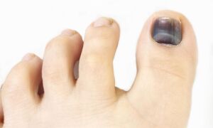 Наиболее вероятные причины появления темного пятна на ногте большого пальца ноги