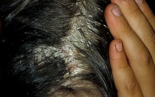 Клинические проявления и методы лечения дерматита кожи головы