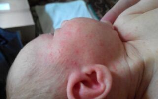 Как избежать появления младенческих угрей и их профилактика