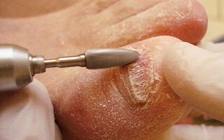 Как проводят процедуру удаления ногтя при онихомикозе