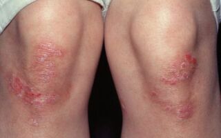 Разновидности псориаза на ногах и методы его лечения