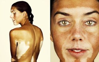 Причины нарушения пигментации кожи и лечение недуга