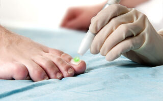 Симптомы и лечение кандидамикоза ногтей