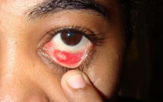 Ячмень на глазу: методы лечения, профилактики фурункулеза