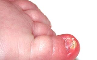 Причины появления грибковых заболеваний ногтей у ребенка и их лечение