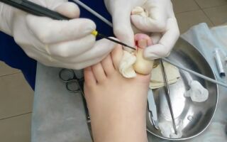 Причины возникновения и методы лечения вросшего ногтя на ноге