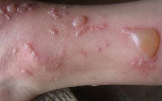 Причины появления и лечение буллезного дерматита